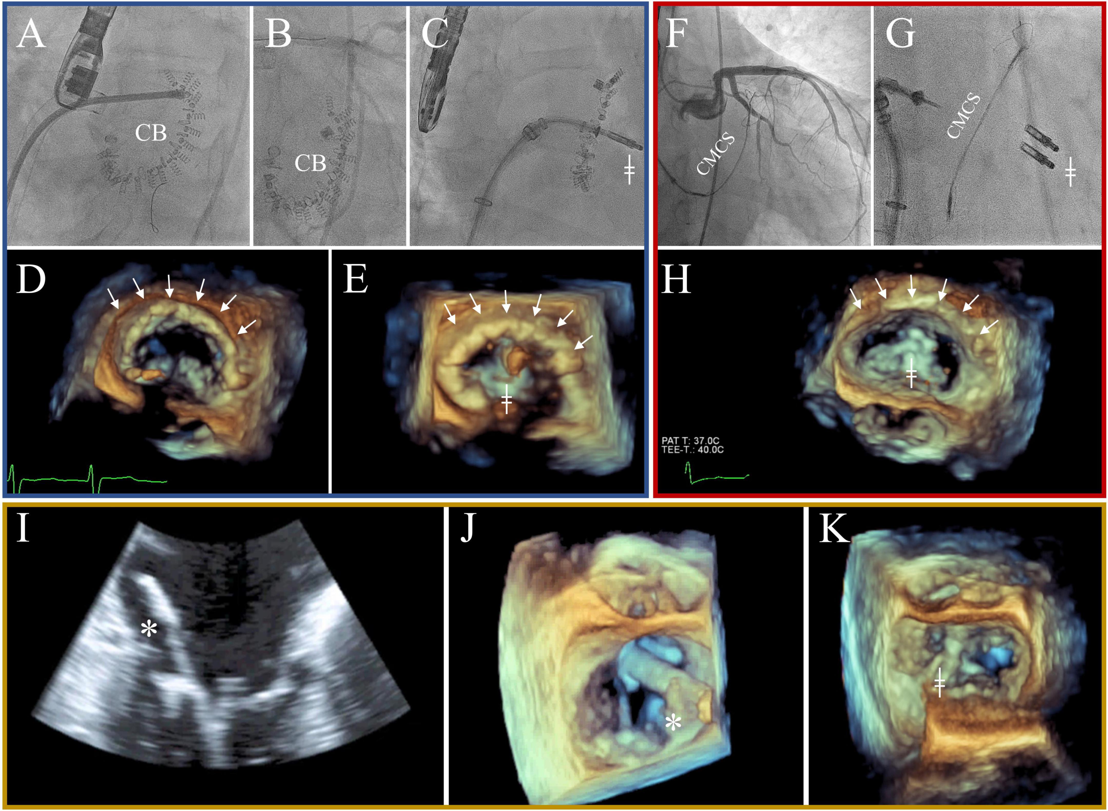 Reverse cardiac remodeling in patients undergoing combination therapy of transcatheter mitral valve repair